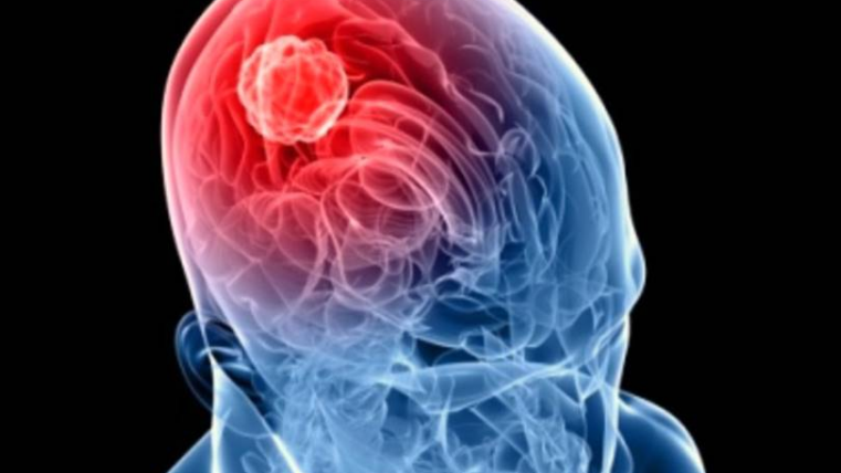 meningite